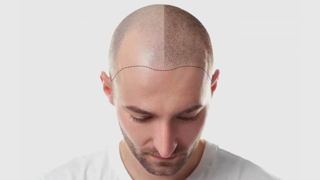 Hair transplantation: what should be taken care of before and after the operation?